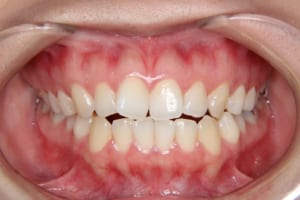 前歯部の叢生、開咬、舌突出癖が見られます